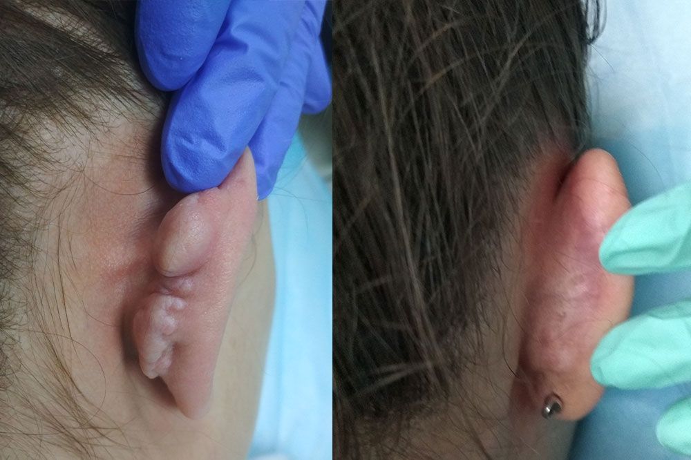 келоидный рубец правого уха до и после лазерной коррекции