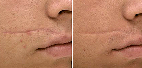Фото до и после FT Коррекция рубцов, шрамов, растяжек