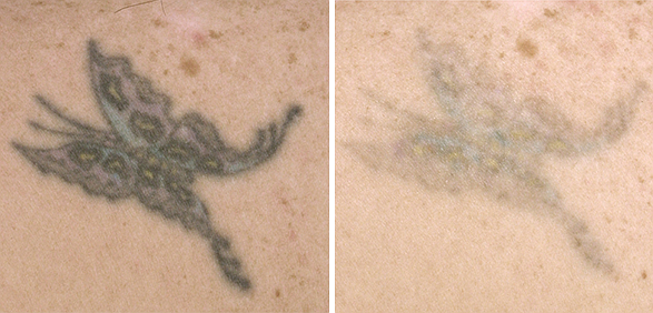 Фото до и после FT Удаление татуировок