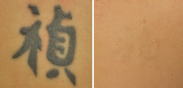 Фото до и после FT Удаление татуировок