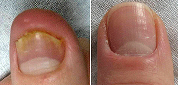 FT Лечение грибковых поражений ногтей