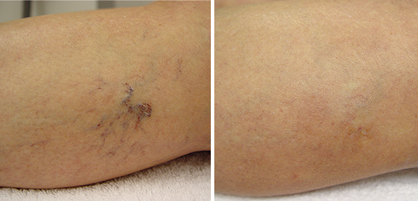 Фото до и после FT Лечение варикоза