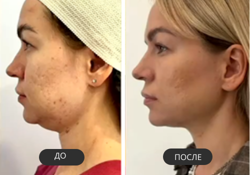 Результаты лазерного эндолифтинга Fotona Endoliftase