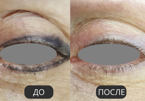 Удаление перманентного макияжа Удаление перманентного макияжа