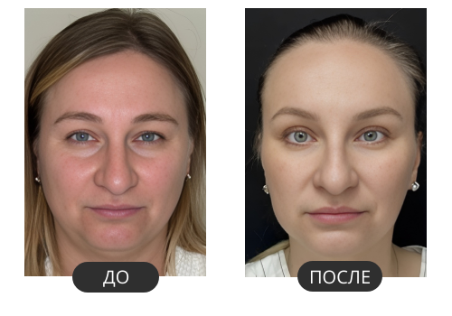 до и после Fotona