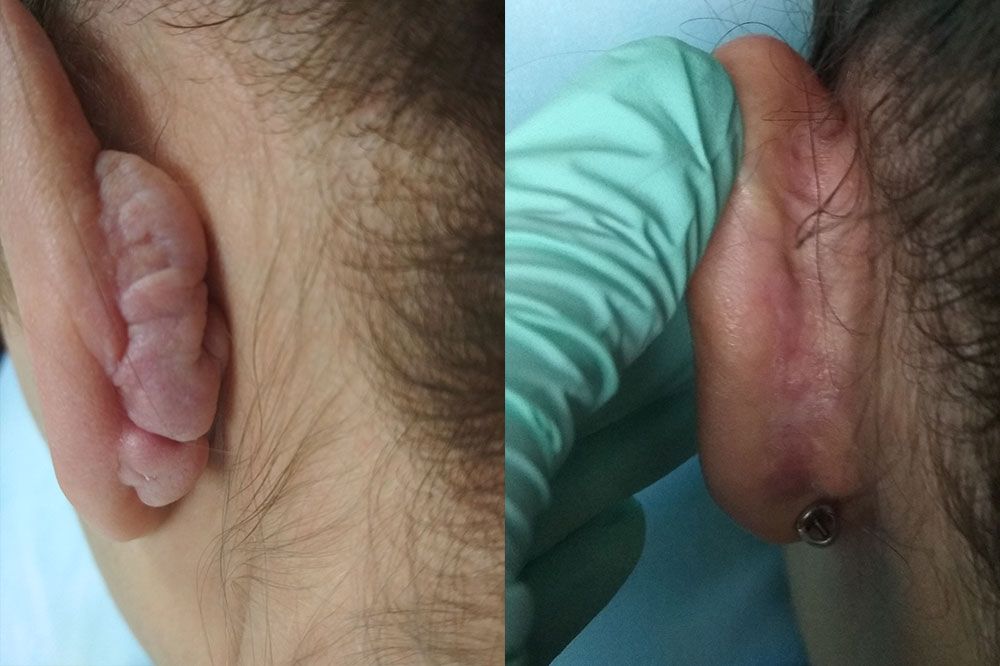 келоидный рубец левого уха до и после лазерной коррекции