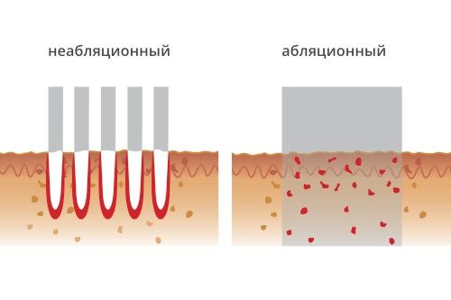 Комбинированные методы лечения рубцов постакне