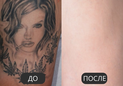 Удаление тату Удаление тату