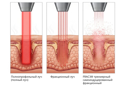 Полнопрофильный луч и FRAC3