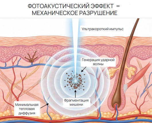 Фотоакустический эффект Fotona