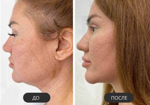Эндолифтинг Fotona до и после