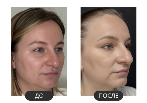 До и после Fotona