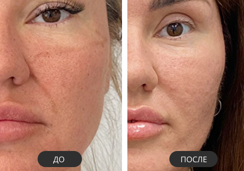 Эндолифтинг Fotona до и после