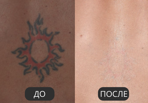 Удаление тату Удаление тату