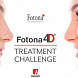 Fotona4D® Treatment Challenge
