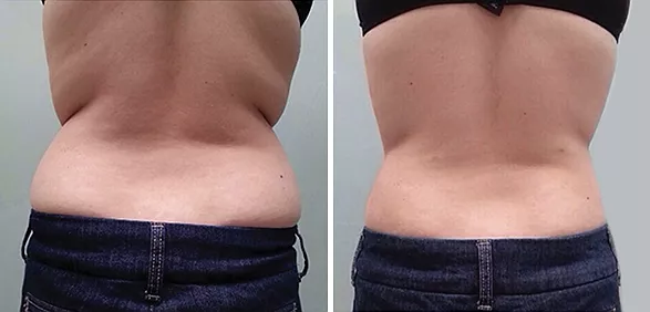 Фото До и После FT Коррекция тела и уплотнение кожи TightSculpting