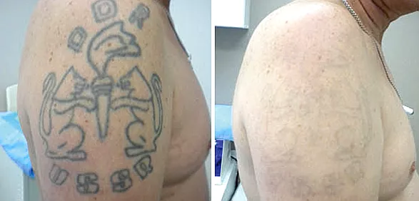 Фото До и После FT Удаление татуировок