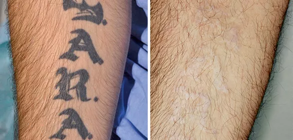Фото До и После FT Удаление татуировок