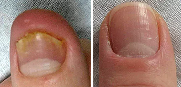 Фото До и После FT Лечение грибковых поражений ногтей