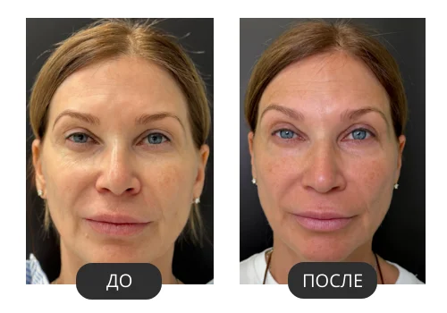 FOTONA 4D®: фото до и после, пример 2 из материалов российского поставщика