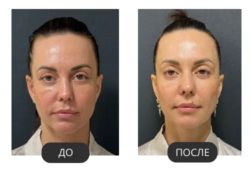 FOTONA 4D®: фото до и после, пример 1 из материалов российского поставщика